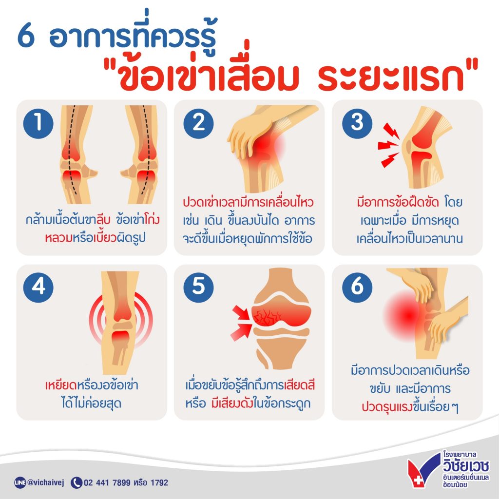 6 อาการที่ควรรู้ “ข้อเข่าเสื่อมระยะแรก”