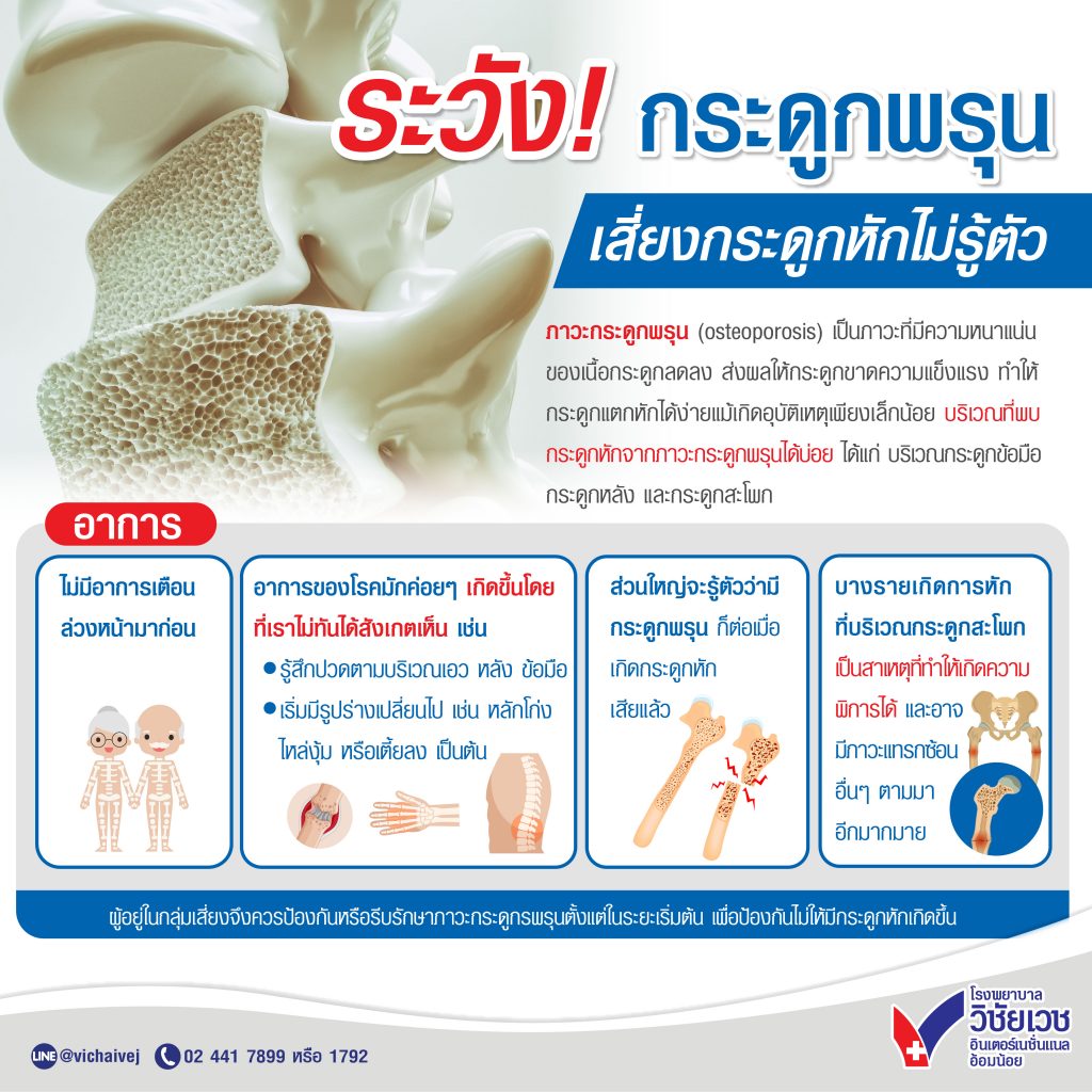 ระวัง! กระดูกพรุน เสี่ยงกระดูกหักไม่รู้ตัว
