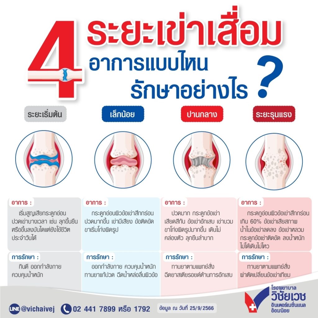 4 ระยะเข่าเสื่อม อาการแบบไหน รักษาอย่างไร?