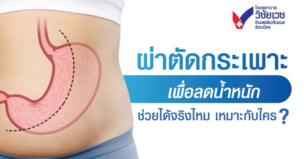 ผ่าตัดกระเพาะ เพื่อลดน้ำหนัก ช่วยได้จริงไหม เหมาะกับใคร?