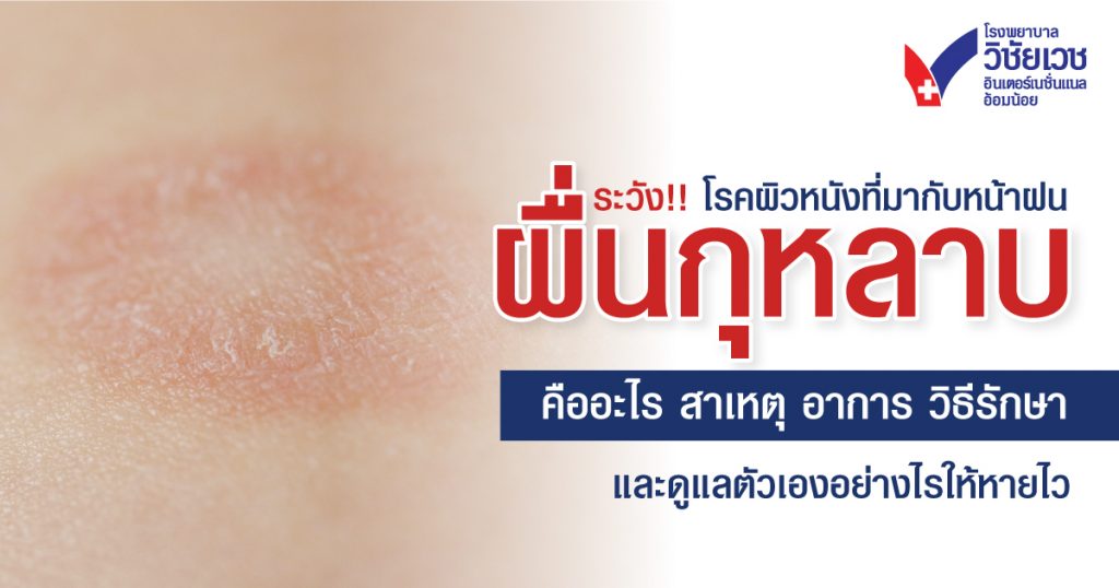 ระวังโรคผิวหน้าฝน! ผื่นกุหลาบ คืออะไร สาเหตุ อาการ วิธีรักษา และดูแลให้หายไว
