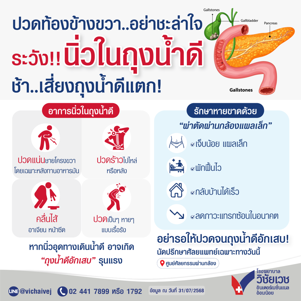 ปวดท้องข้างขวา…อย่าชะล่าใจ ระวังนิ่วในถุงนี้ำดี
