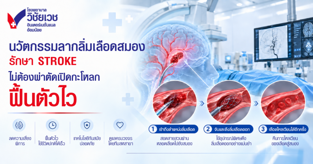 นวัตกรรมลากลิ่มเลือดสมอง (Mechanical Thrombectomy) รักษา Stroke ทันเวลา ไม่ต้องผ่าตัดเปิดกะโหลก